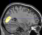 Brain scan from the side, small yellow spots highlighted