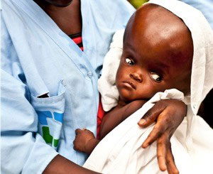 Close up of baby with hydrocephalus with extremely enlarged head held by a health care worker