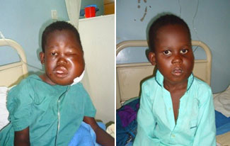 Side by side comparison of boy with Burkitt’s lymphoma before treatment with swollen face and after treatment looking healthy