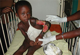 Young child in hospital bed holds up arm, large areas of skin peeling and muscle showing, worker off camera wearing gloves