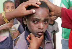 Young boy looks into camera, eyes very red, face dirty, adult hands rest on his head and chin to examine him