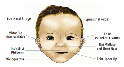 Illustration of child's face showing symptoms of Fetal Alcohol Syndrome, full description immediately follows