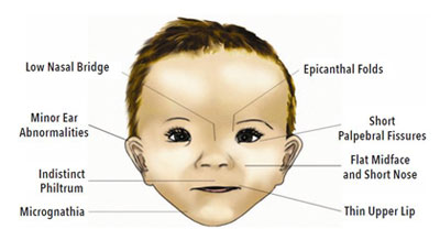 illustration-fetal-alcohol-syndrome-visual-defects.jpg