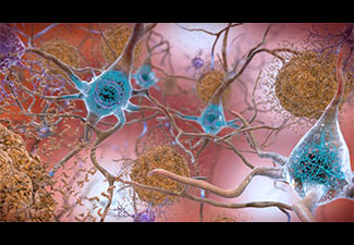 Beta-amyloid plaques and tau in the brain