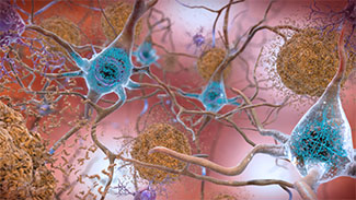 Image of bright blue protein clumps form plaques in an Alzheimer's affected brain