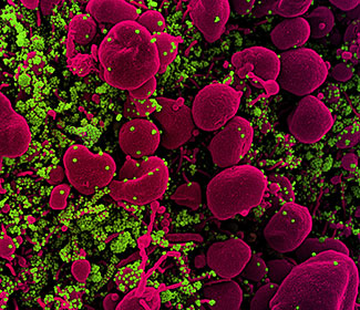 Colorized scanning electron micrograph of an apoptotic cell (pink) heavily infected with SARS-CoV-2 virus particles (green).