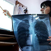 Dr. Lali Mikishivili reviews a TB patient's x-ray at the Georgian National Center for Tuberculosis and Lung Disease