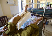 In a hospital bed, a patient’s injured leg, which is covered in bandages, is elevated. 