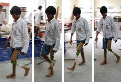 PHOTO: Four panes show a young man in various stages of taking steps toward the camera, with an artificial thigh, knee, leg