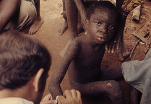 Photo: Young boy seated on ground and covered in smallpox rash, stares into camera, seated, man dabs boy’s rash, adults close by