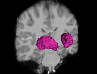 Brain scan shown from the back, small pink spots highlighted
