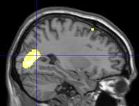 Brain scan from the side, small yellow spots highlighted