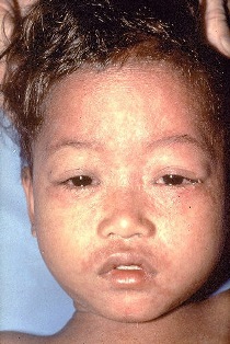 A mugshot of a boy with measles. Photo: CDC