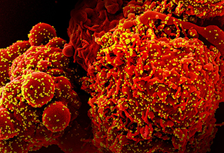 A colorized scanning electron micrograph of a cell (red) infected with the Omicron strain of SARS-CoV-2 virus particles (yellow), isolated from a patient sample.