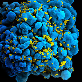 Scanning electron micrograph of an HIV-infected H9 T cell