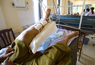 In a hospital bed, a patient’s injured leg, which is covered in bandages, is elevated.