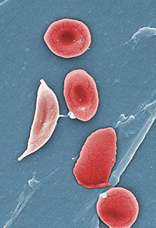 Slide showing red blood cells of someone with sickle cell disease.